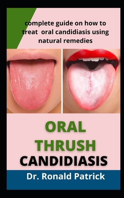 Oral Thrush Candidiasis: Complete Guide on How to Treat Oral ...